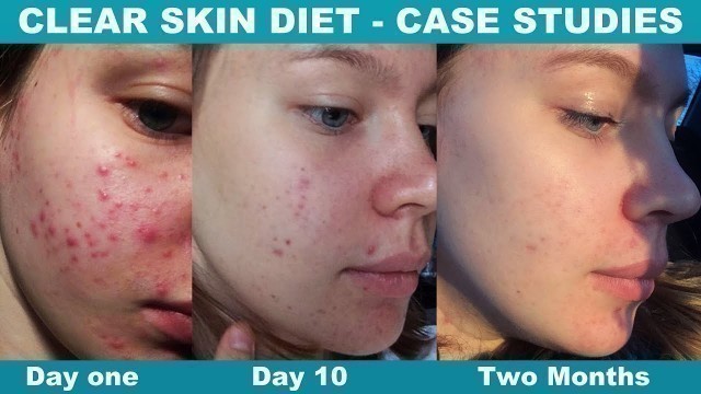 'Change Your Diet, Clear Your Acne'