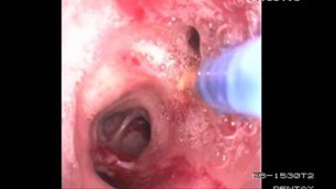 'Bronchoscopy Procedure - See inside the lungs!'