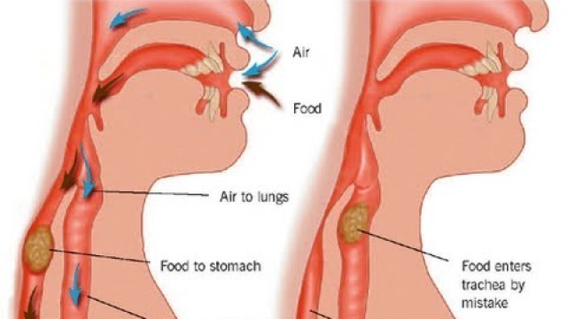 'Aspiration Pneumonia'