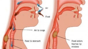 'Aspiration Pneumonia'