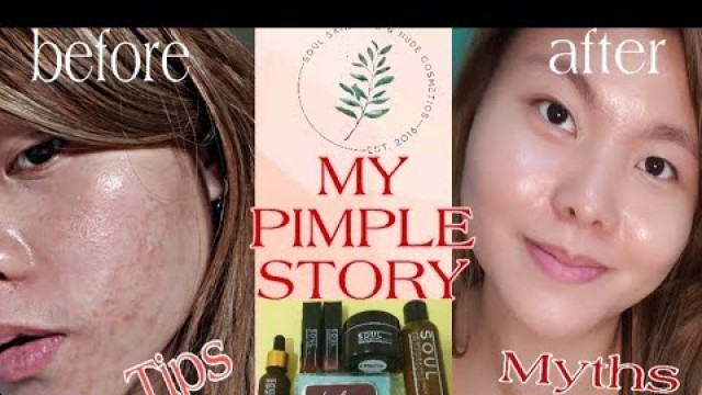 'REMOVING PIMPLES: CAUSES, MYTHS AND MY STORY || SOUL SKIN FOOD AND NUDE COSMETICS'