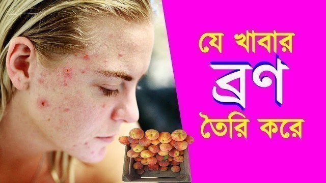 'যে পছন্দের খাবারগুলো ব্রণ তৈরি করে ।। Foods That Cause Pimples and Acne ।। Acne Prevent Tips'