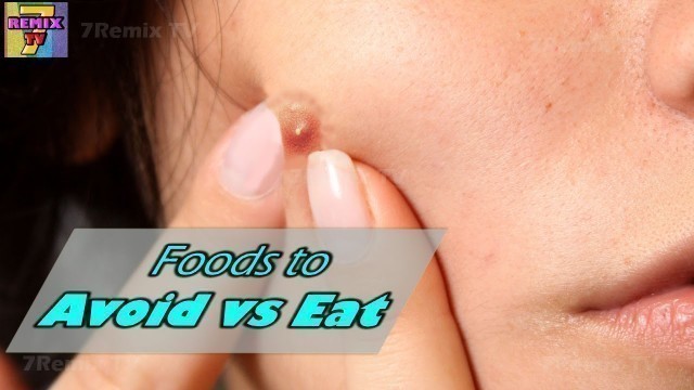 'Foods to AVOID and EAT to get rid of Acne & Pimples Breakout'