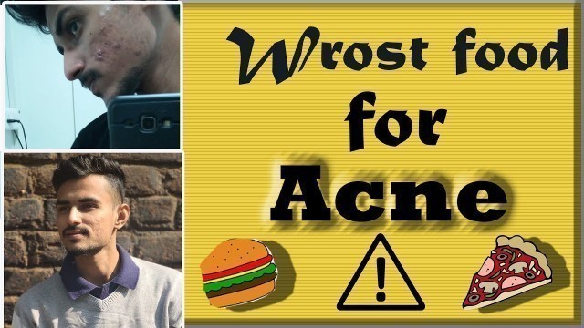 'Worst food for Acne & Pimples ⚠️ ‌‌। Hindi'