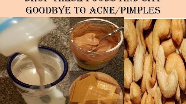 'Acne : Drop these Foods and say Goodbye to Acne Pimples'