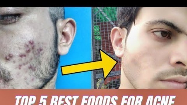 'Top 5 Best Food For Acne And Pimples | Best Foods To Cure Acne'