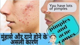 'Main causes of Acne and Pimples on face || ( In hindi )'