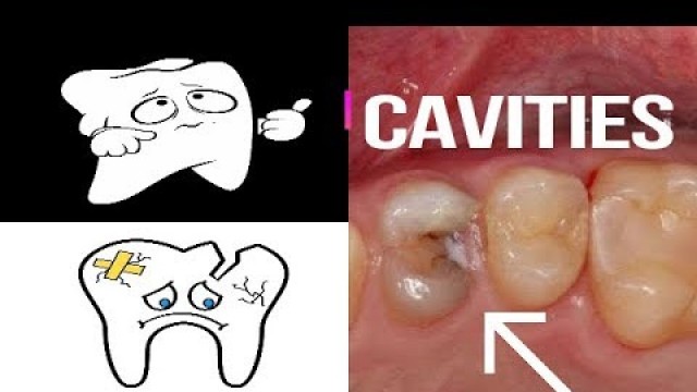 'What Causes Cavities - Lemon, Bacteria, Germs, Corn Syrup, Amoeba, Protozoa, Kissing'